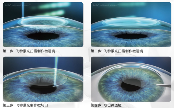 惠州?，斄猪槼毖劭漆t(yī)院全飛秒激光近視手術(shù)過(guò)程