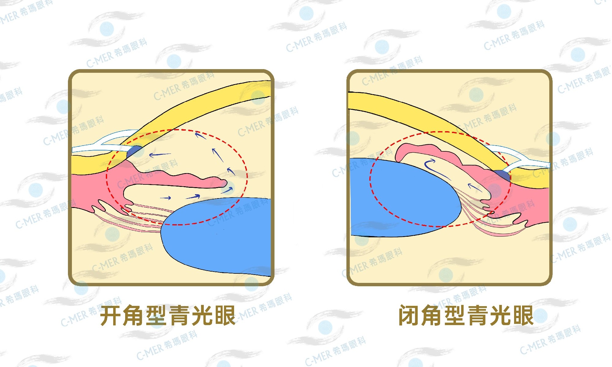 這種眼病不只是老年病，年輕人也要警惕！