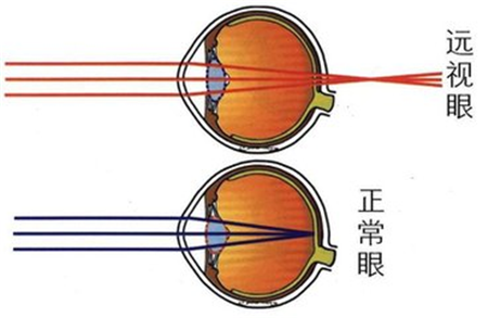 遠(yuǎn)視,怎么,矯正,三種,方式,如果,看見,一個(gè)人,