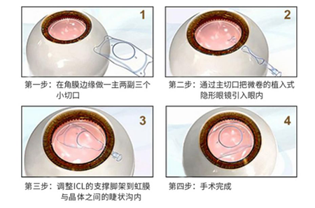 近視,近視手術(shù),近視矯正,半飛秒,全飛秒,icl