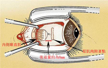 斗雞眼,斜視,兒童斜視,嬰幼兒斜視,內(nèi)斜視,斜視手術(shù)