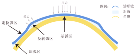 近視,眼鏡,度數(shù)加深,近視加深,角膜塑形鏡