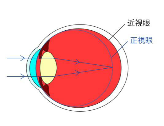 近視眼