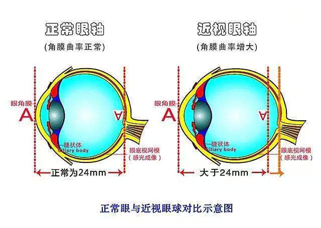 正常眼與近視眼