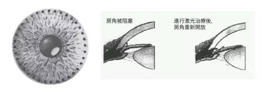 干眼癥,急性青光眼,眼中風,惠州希瑪眼科醫(yī)院