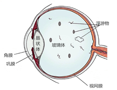 飛蚊,病癥,玻璃體,視網(wǎng)膜,惠州希瑪眼科醫(yī)院