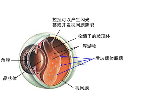 飛蚊,病癥,玻璃體,視網(wǎng)膜,惠州?，斞劭漆t(yī)院