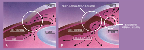 白內(nèi)障,黃斑轉(zhuǎn)性,青光眼,惠州?，斞劭漆t(yī)院