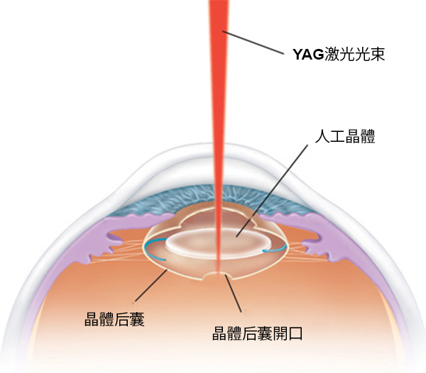 白內(nèi)障,白內(nèi)障手術(shù),惠州?，斞劭漆t(yī)院