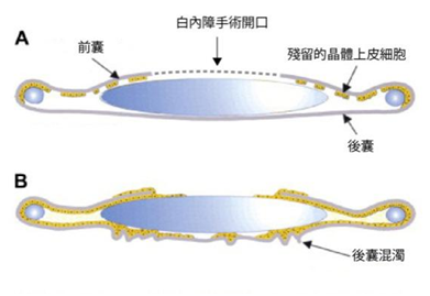 白內(nèi)障,白內(nèi)障手術(shù),惠州?，斞劭漆t(yī)院