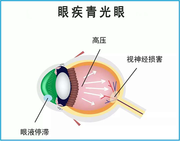 青光眼,惠州治療青光眼,惠州希瑪眼科醫(yī)院