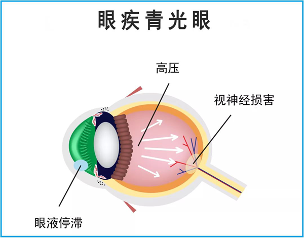 青光眼,青光眼的癥狀,青光眼的治療,青光眼的診