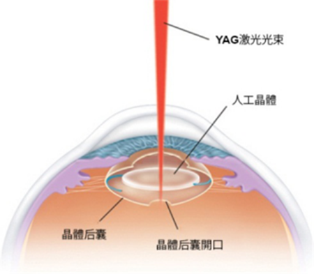 白內(nèi)障,白內(nèi)障手術(shù),惠州希瑪眼科醫(yī)院